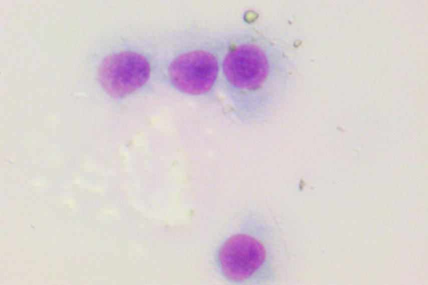 Mittels zytologischer Untersuchung kann die Diagnose sofort gestellt werden.