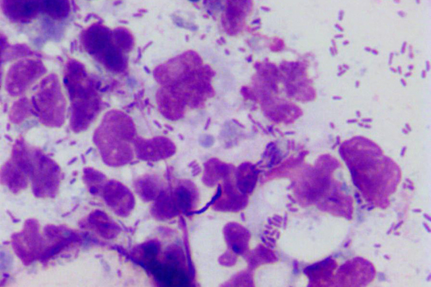 Otitis Rods