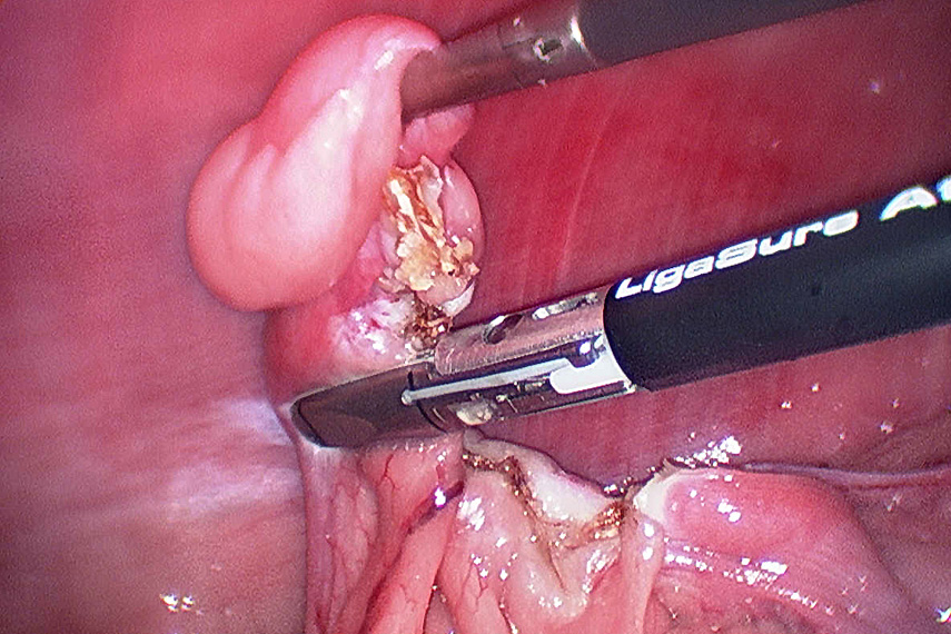 Endoskopische Kastration
