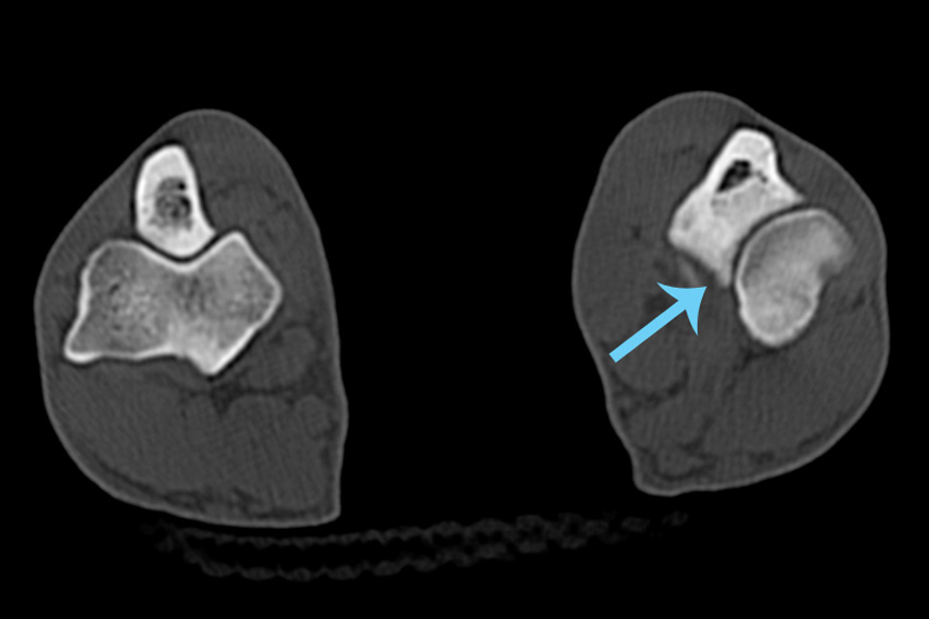 CT-Fissur am Proc. Coronoideus