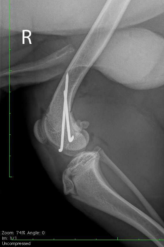 Salter Harris Fraktur post-op