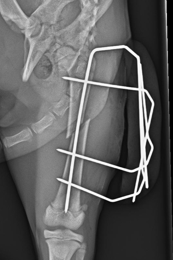 Fixateur Femur