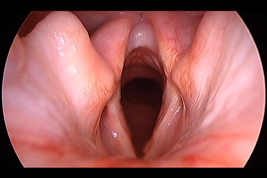 Kehlkopflähmung, Larynxparalyse